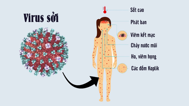 TÌM HIỂU VỀ BỆNH SỞI